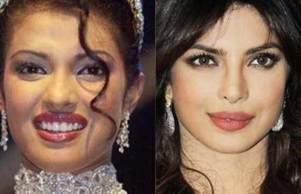 Lip-Job-Priyanka-Chopra