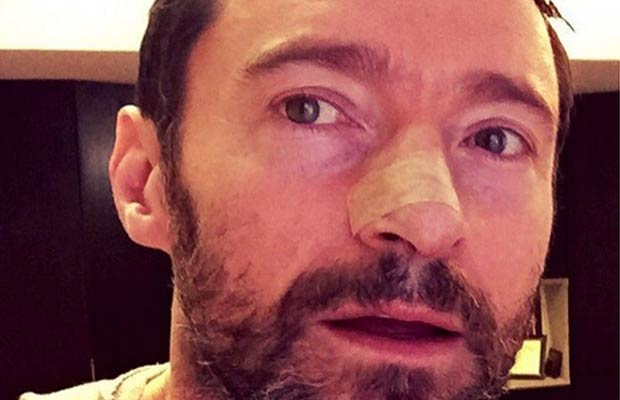 Wolverine Star Hugh Jackman Reveals On Being Treated For Skin Cancer Again!