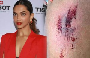 Injury On The Sets Of Deepika Padukone's 'xXx: The Return of Xander Cage'