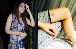 Kriti Sanon Injured On The Sets Of Raabta