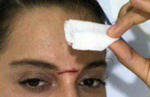 Photo: Kangana Ranaut Hospitalised After Being Hit By Sword On Sets Of Manikarnika!